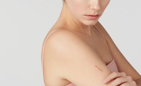 Bioderma - woman with scar