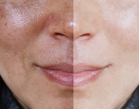 Bioderma pigmentbio hiperpigmentacije