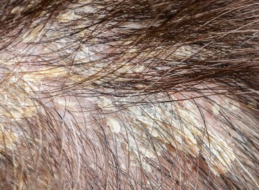 seborrheic dermatitis on the scalp